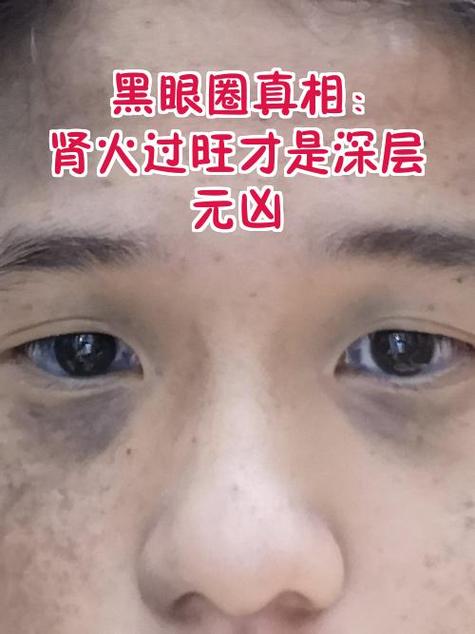 熊猫眼是什么病的前兆