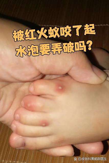 红蚂蚁咬了会自愈吗